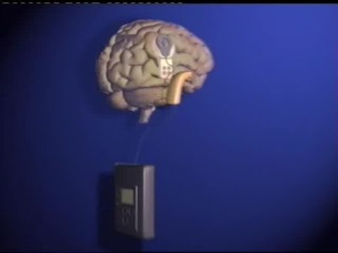 Una niña sorda de 13 meses puede oír gracias a un revolucionario implante