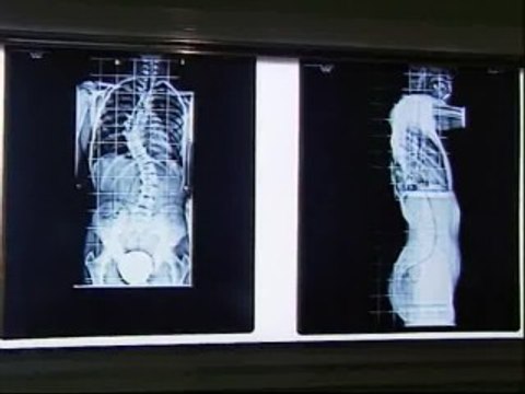 Doctores españoles desarrollan una nueva técnica para corregir la escoliosis