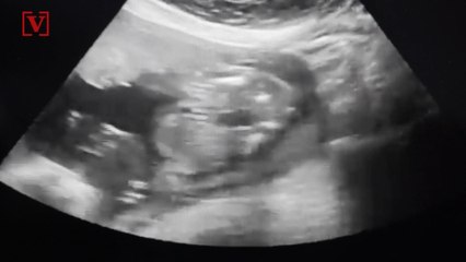 A Baby Girl in Colombia Was Born With Her Twin Inside Her Abdomen