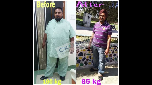 PATIENT TESTIMONIAL | DR AMIT SOOD | WEIGHT LOSS SURGERY | WEIGHT LOSS SURGEON | LAPAROSCOPIC SURGEON