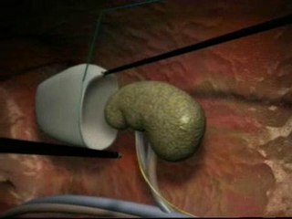 Extraer un riñón a través del ombligo