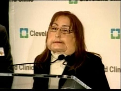 Aparece en público la mujer a la que se le trasplantó el 80% del rostro