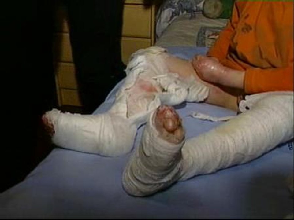 Los médicos buscan soluciones para la "Piel de mariposa"