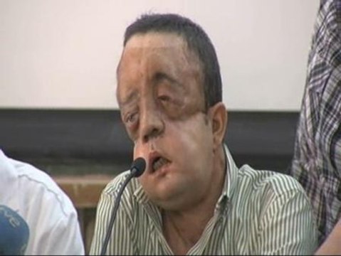 Rafael, primer trasplantado de cara en Andalucía: Quiero dar las gracias a todo el equipo médico