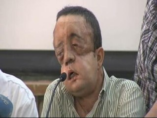 Rafael, primer trasplantado de cara en Andalucía: "Quiero dar las gracias a todo el equipo médico"