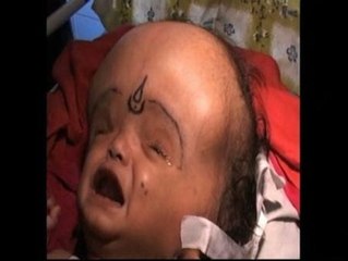 Abandonan a un bebé con hidrocefalia