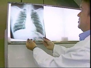 Importante avance en la lucha contra la EPOC