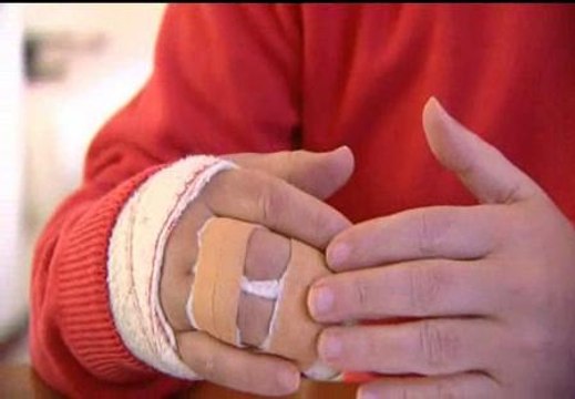 Un dedo roto en un efusivo apretón de manos entre alcaldes