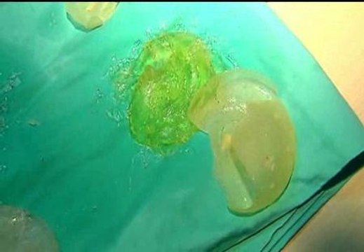 Primera condena a un cirujano español por colocar un implante PIP sin informar de los riesgos