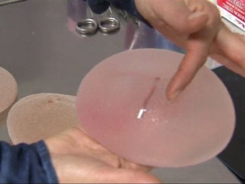 Sanidad recomienda la retirada de todas las prótesis PIP