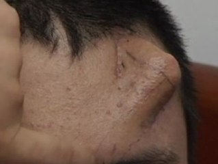 Le hacen crecer una nariz en la frente para sustituirla después por la original