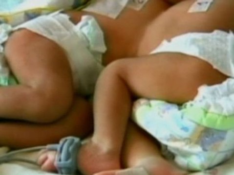 Dos siamesas bolivianas de cuatro meses han sido operadas para ser separadas