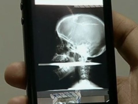 Una brasileña sobrevive al disparo de un arpón que le atravesó la boca y la médula espinal