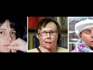 Sexto transplante completo de cara en EEUU