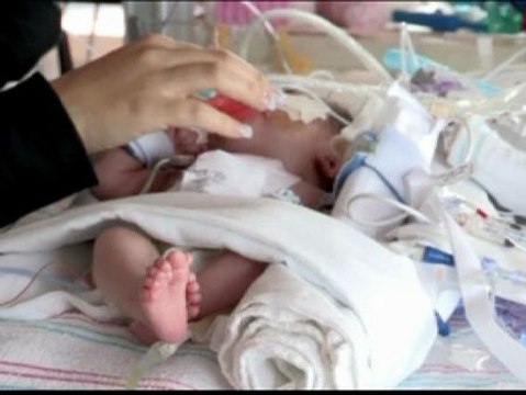 Una niña de tres meses salva la vida pese a nacer con el corazón fuera