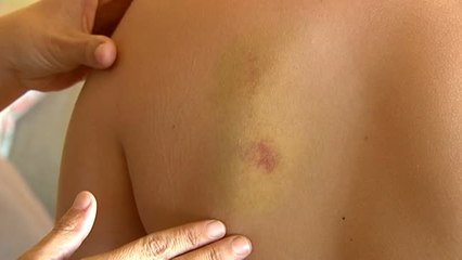 Un niño hemofílico recibe una paliza por parte de seis compañeros de su instituto