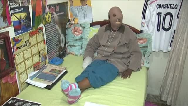 Una mujer colombiana atacada con ácido cancela su eutanasia tras hablar con el Papa