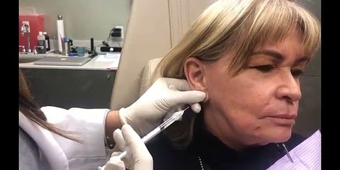 Earlobe Repair Non Surgical With Dr. Monica Tadros
