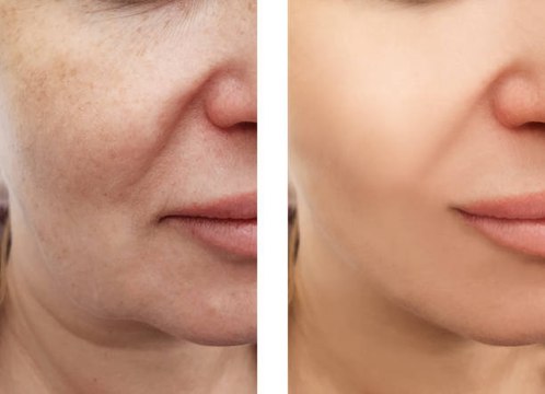 Taches brunes : 6 remèdes de grand-mère