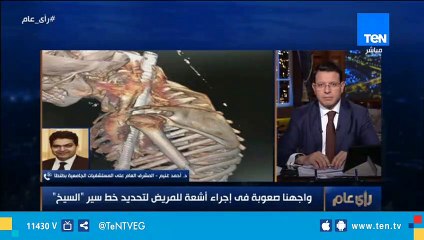 المشرف العام على المستشفيات الجامعية بطنطا يكشف تفاصيل عملية إستخراج "سيخ حديد" اخترق جسد طفل في طنطا