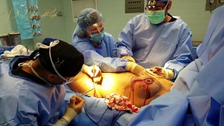Liposuction or Breast Reduction