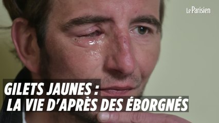 Gilets jaunes : la vie d'après des éborgnés