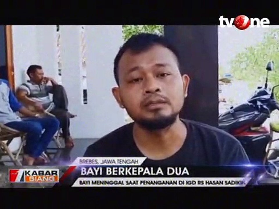 Bayi Berkepala Dua Asal Brebes Meninggal Dunia di RS