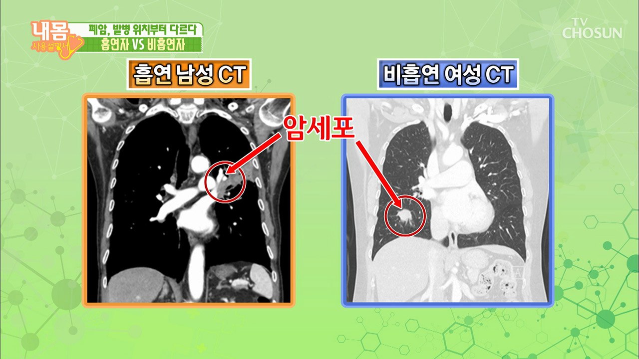 폐암, CT 사진만으로 흡연 여부를 알 수 있다? [내 몸 사용설명서] 247회 20...