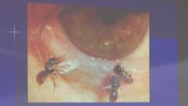 Doctors remove ‘sweat bees’ living off tears in Taiwanese woman’s eye