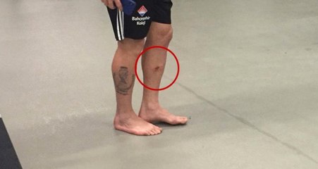 Beşiktaş'ın Şilili Oyuncusu Gary Medel'in Bacağı Delindi!