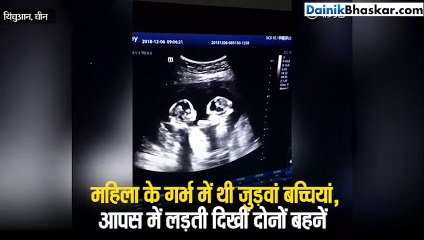 twin sisters fighting in womb