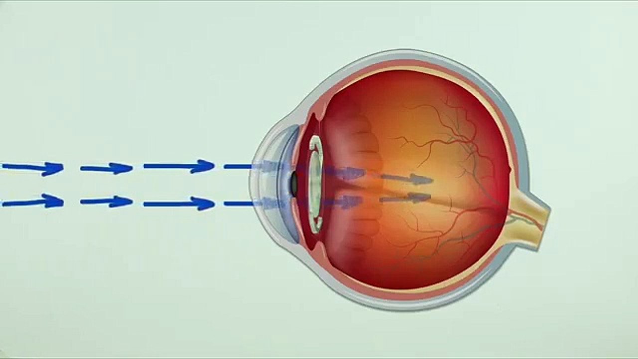 Akıllı lens nasıl takılır?