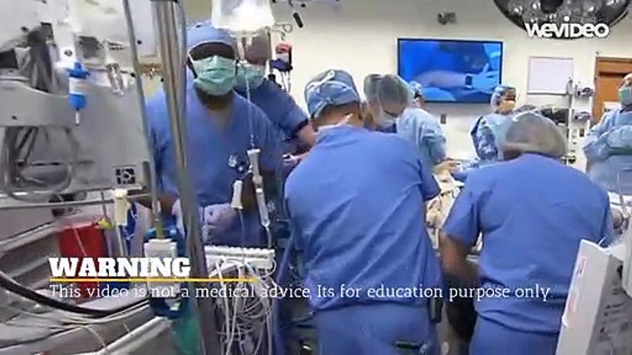 Abdominal Adhesions (Scar Tissue Formation)