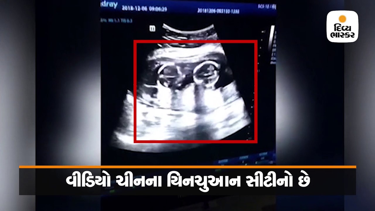 માતાના પેટમાં જ જુડવા બાળકીઓએ કરી લડાઈ, પિતાએ શ...