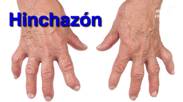 La artritis__Te contamos todo lo que debes saber acerca de la artritis, una enfermedad autoinmune la cual afecta las pequeñas..._HD