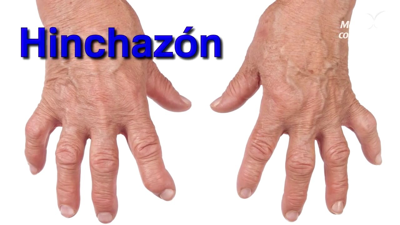 La artritis__Te contamos todo lo que debes saber acerca de la artritis, una enfermedad autoinmune la cual afecta las pequeñas..._HD