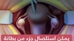 فيديو معلوماتى.. 4 أشياء يجب معرفتها قبل استئصال الرحم