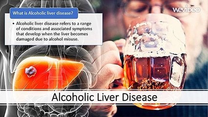 Alcoholic fatty liver disease : Itroduction, Stage