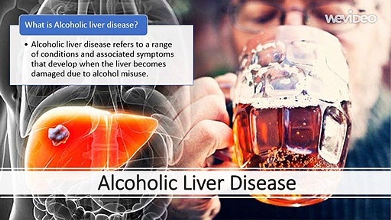 Alcoholic fatty liver disease : Itroduction, Stage