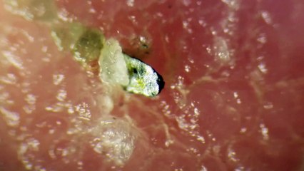 Removing Metal Splinter From Skin + Magnet (GROSS)