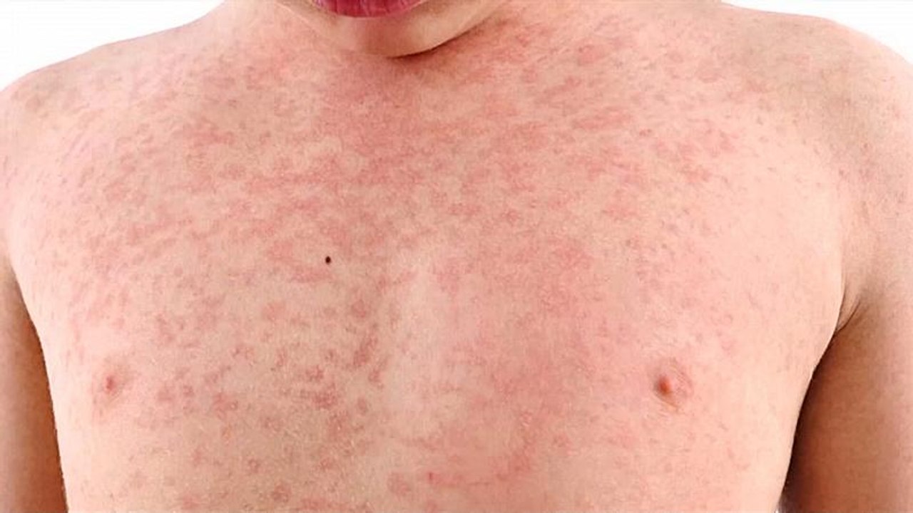 La rougeole est bel et bien de retour, les Etats-Unis particulièrement impactés