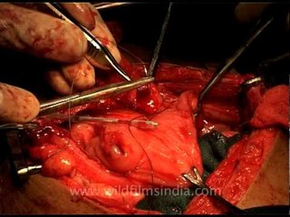 Surgical suture to mend a defected abdomen!