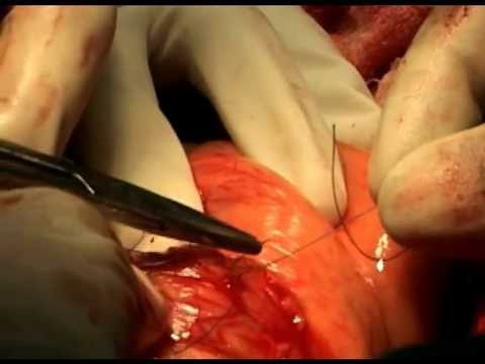 Internal abdominal surgical stitching