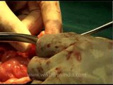 Surgery that will send chills down your spine!