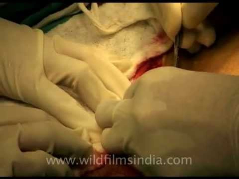 Abdominal surgery