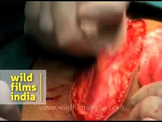 Cutting through the abdomen for surgery....