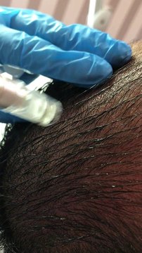 Doğal ve etkili saç çıkarma yöntemi (saç çoğaltma formülü)