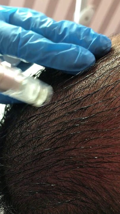 Doğal ve etkili saç çıkarma yöntemi (saç çoğaltma formülü)