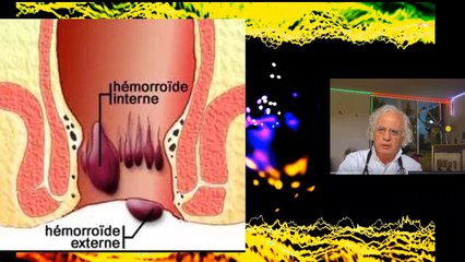 452 HEMORROIDES CE QU'ON VOUS DIT JAMAIS DÉMANGEAISON ANALE CONSTIPATION COLOPATHIE BIEN-ÊTRE SANTÉ