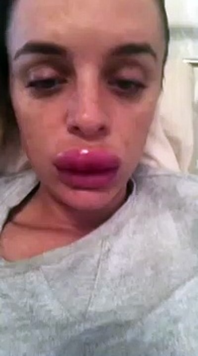 Rachael Knappier's swollen lips after a lip filler treatment went horribly wrong